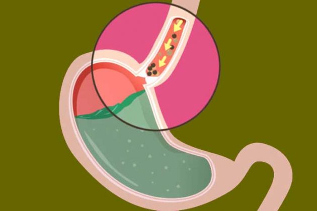 Gastric Reflux: What To Eat?